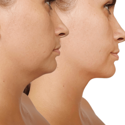 SKIN TIGHTENING
